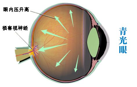 什么类型青光眼要用药物控制眼压?