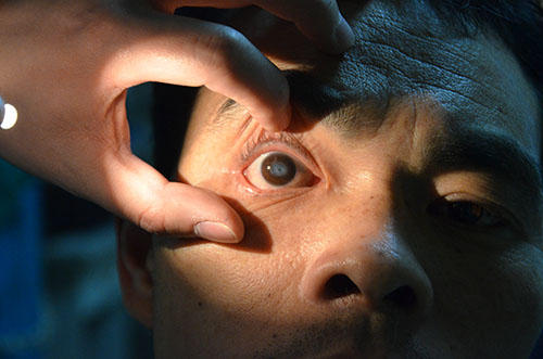 角膜移植手术的成功率有多高?